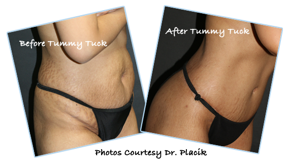 Cosmetic Vaginal Surgery Atlanta, Labiaplasty