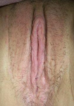 After-Labiaplasty