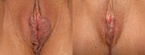 Vaginoplasty Before and After Photos.